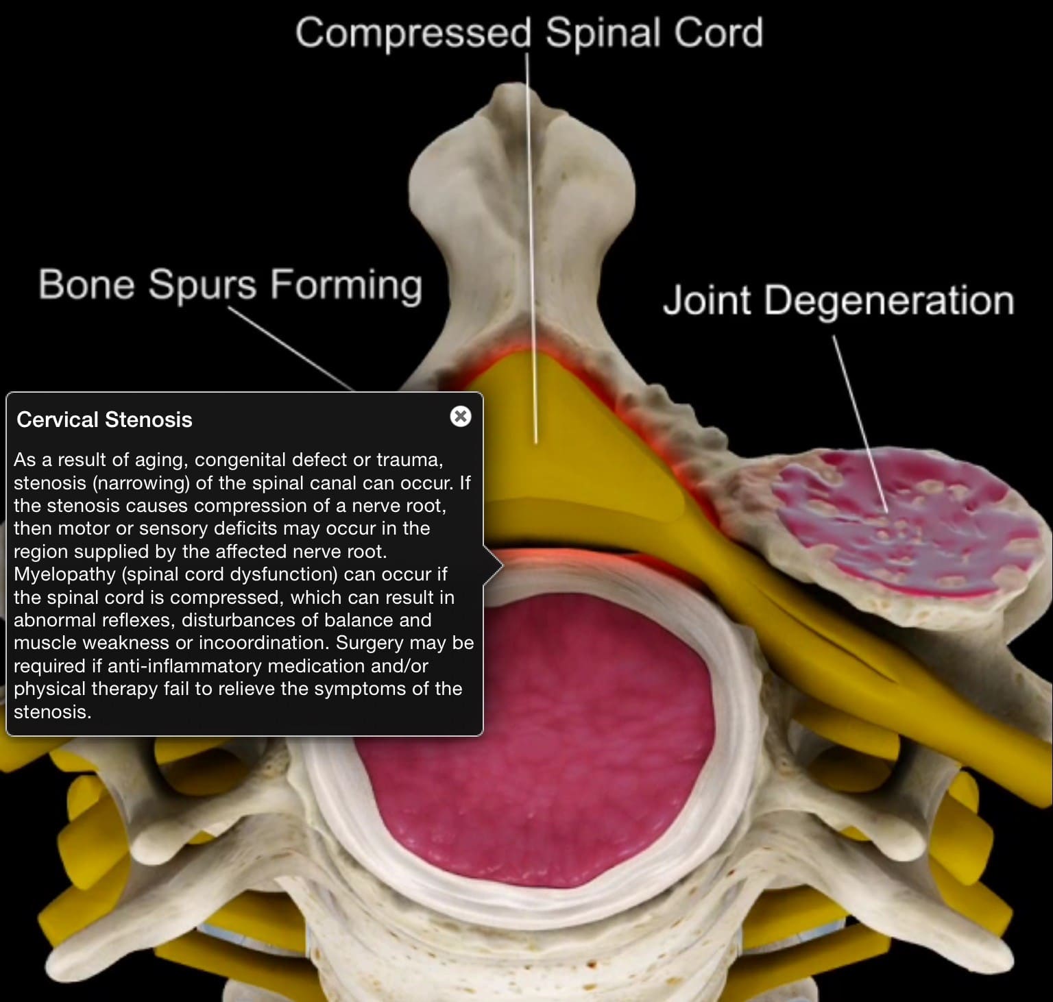 spine third